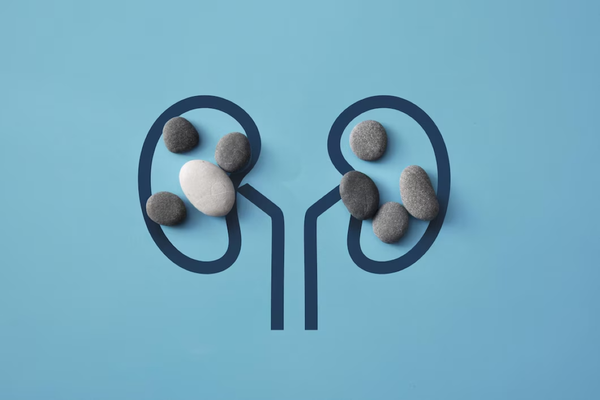 Kidney Stones: Symptoms, Risk Factors, and Its Causes