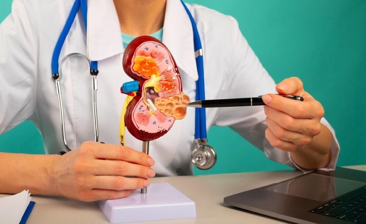 Kidney Stone Myths: Debunking Common Misconceptions