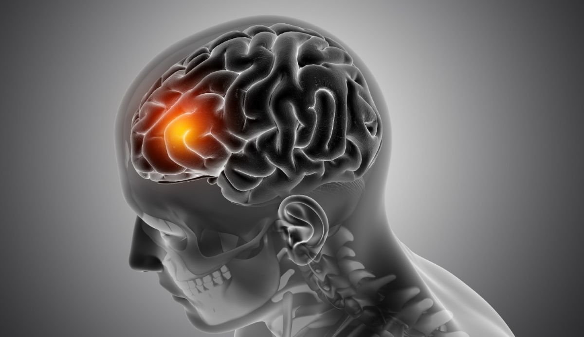Recognizing Signs and Symptoms of a Stroke