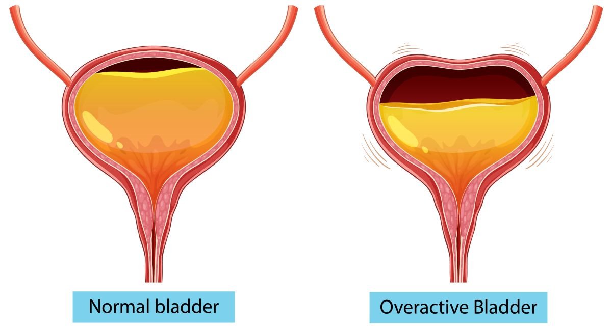 Overactive Bladder: Symptoms, Causes, and How to Cope Effectively
