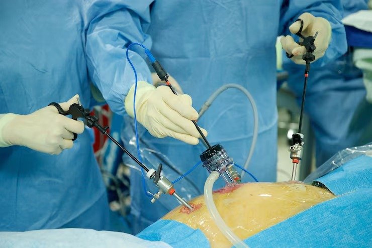 Laparoscopy for Gallbladder Removal: What to Expect